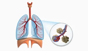 Eine anatomische Illustration der menschlichen Lunge zeigt die Atemwege und Blutgefäße, die in die Lungenflügel führen. Im vergrößerten Kreis ist eine Nahaufnahme der Alveolen zu sehen, kleine luftgefüllte Strukturen, die von Blutgefäßen umgeben sind, welche für den Gasaustausch im Körper verantwortlich sind.