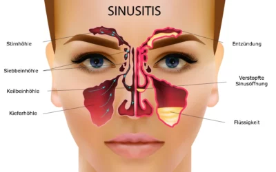 Sinusitis – Was ist eine Nasennebenhöhlenentzündung?