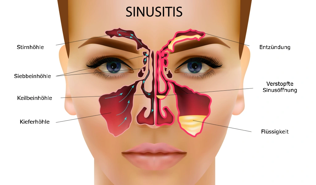 Sinusitis – Was ist eine Nasennebenhöhlenentzündung?