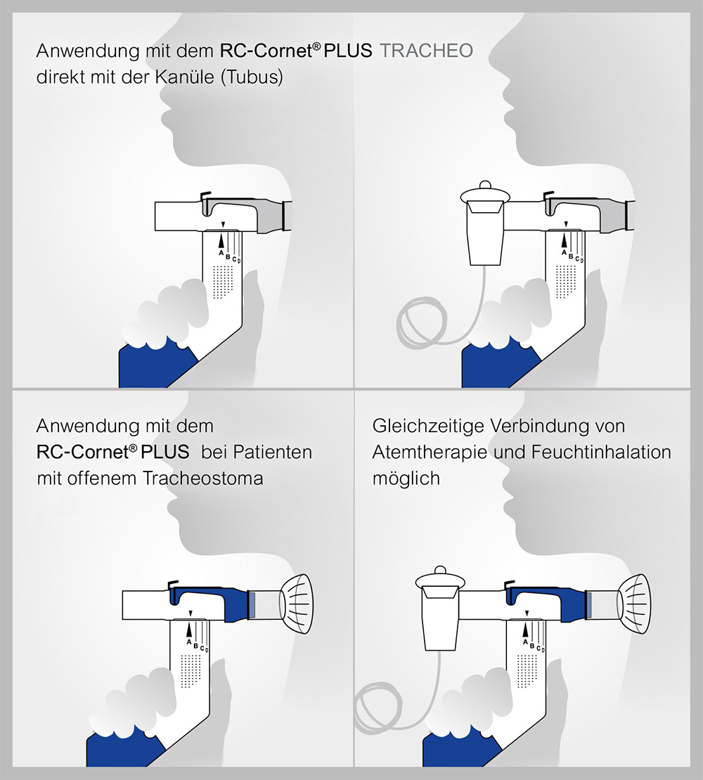 Anwendung des RC-Cornet® PLUS TRACHEO